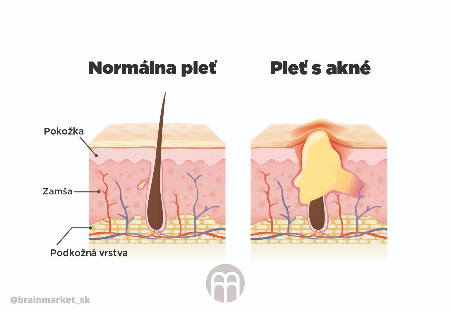 normalni_plet_vs_akne_infografika_brainmarket_CZ